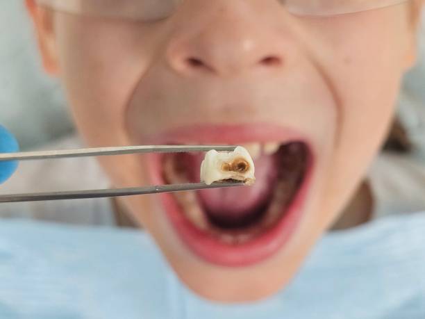 Best Emergency Root Canal Treatment in Newton, TX